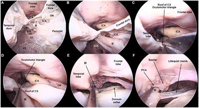 Transorbital approach to the cavernous sinus: an anatomical study of the related cranial nerves
